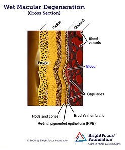 Wet AMD Anatomy